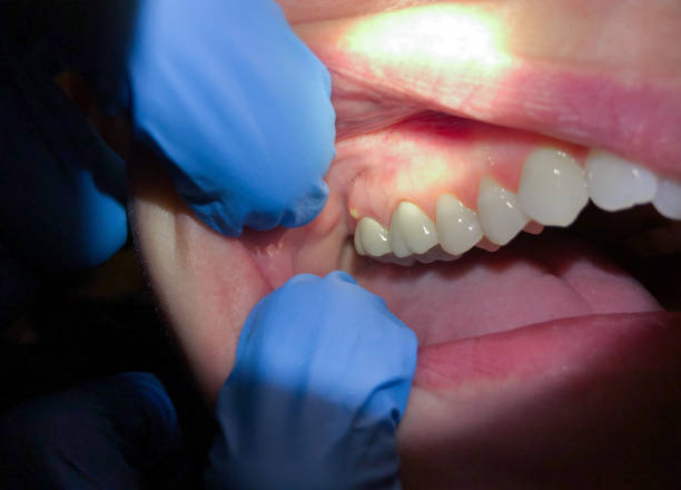 Best Emergency Care for Gum Disease in Gypsum, CO
